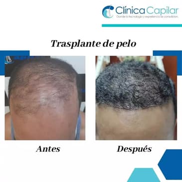 Slider image (7) Clinica Capilar